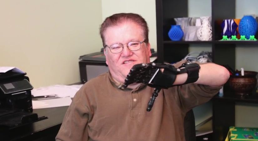 Инвалид от рождения получил бюджетный протез, напечатанный на 3D-принтере