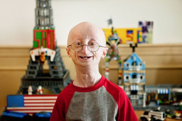 sam-berns-progeria_75423_990x742