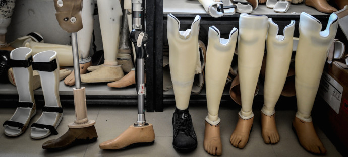 Bali Clinic Produces Prostheses For Local Community