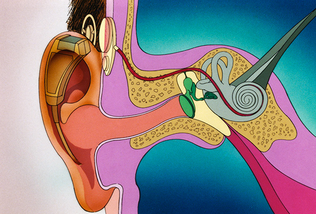  Кохлеарный имплантат — протез, позволяющий компенсировать потерю слуха людям с тяжелой степенью нейросенсорной тугоухости. Микрофон отправляет звуки на компьютер, имплантированный под кожу головы, электроды стимулируют слуховой нерв. Фото: DeAgostini / Getty Images / Fotobank 