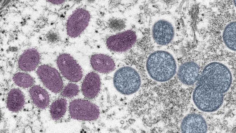 Вирус обезьяньей оспы под электронным микроскопом. Слева - вирусы созревшие, справа - еще нет. Главное опасение медиков заключается в том, что вирус может закрепиться в неэндемичных регионах.