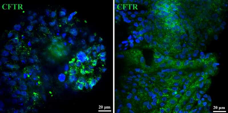 Слева органоиды из клеток дыхательных путей, справа — из клеток легких. Синим (реактив DAPI) окрашены ядра клеток, зеленым — белок CFTR. Видно, что он экспрессируется в обоих типах органоидов, вероятно, полученных от здорового донора